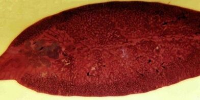 trematodes parazīts, kā noņemt no ķermeņa